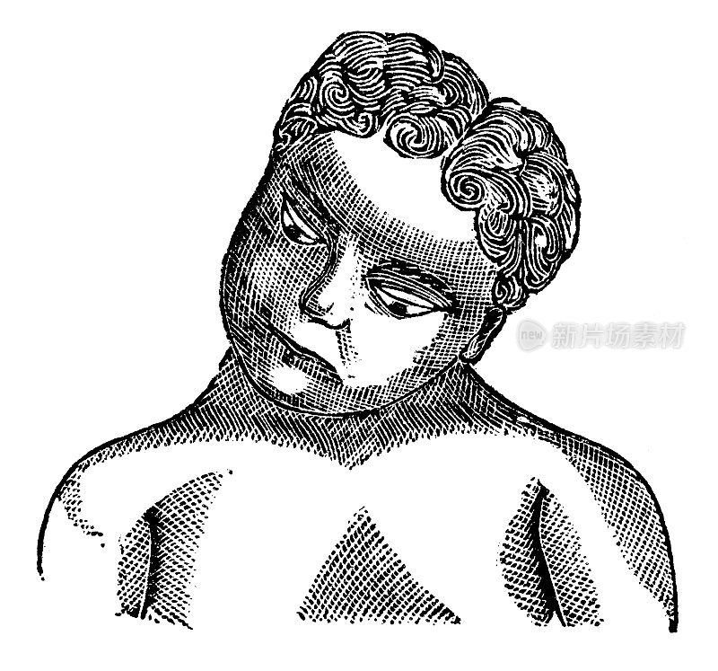 一个患有旋转斜颈(扭颈)的人的医学插图- 19世纪